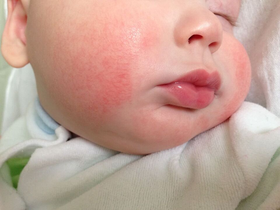 Oznaką robaków u dziecka jest pokrzywka alergiczna